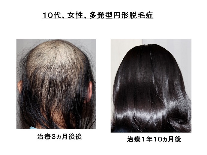 円形脱毛症　病院